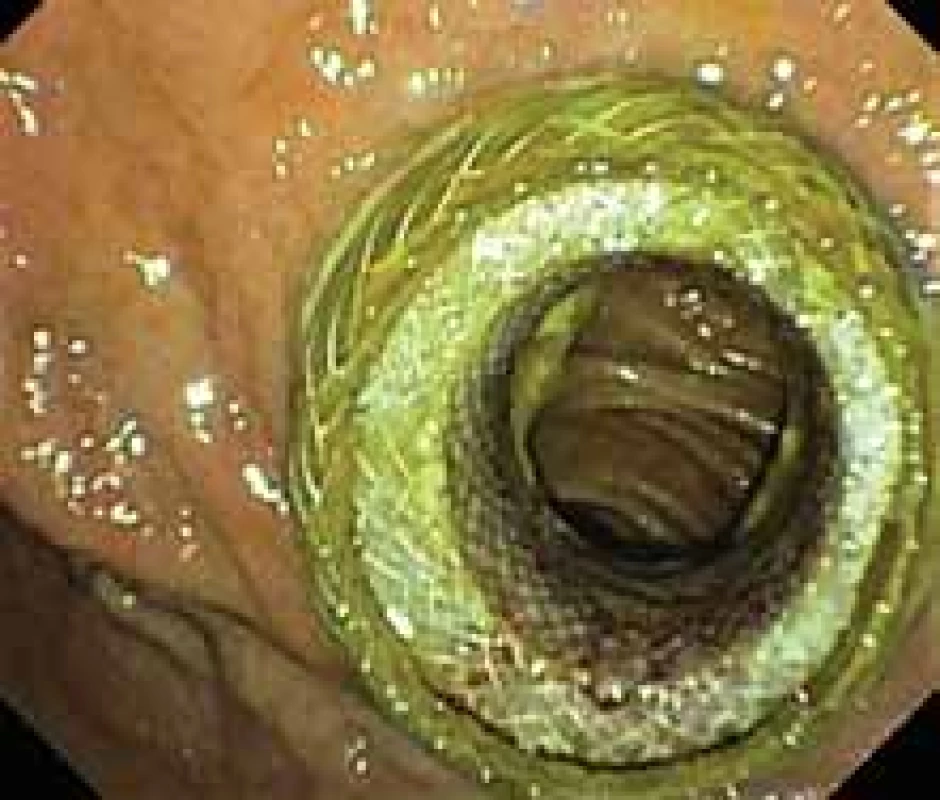 Endoskopická gastroenteroanastomóza.
Plně rozvinutý lumen
apoziční metalický stent Hot-AXIOS.<br>
Endoscopic gastroenteroanastomosis.
Fully developed lumen-apposing
metal stent Hot-AXIOS.
