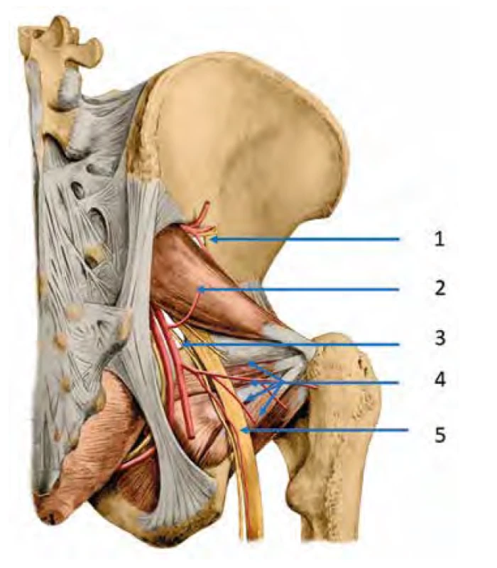 Průběh ischiadického nervu velkým pánevním otvorem.
1. gluteální nervy a cévy odbočující nad m. piriformis. 2. m. piriformis.
3. n. cutaneus femoris dorsalis. 4. mm. gemelli a m. obturator internus.
5. n. ischiadicus (publikováno se svolením autorů) [16]