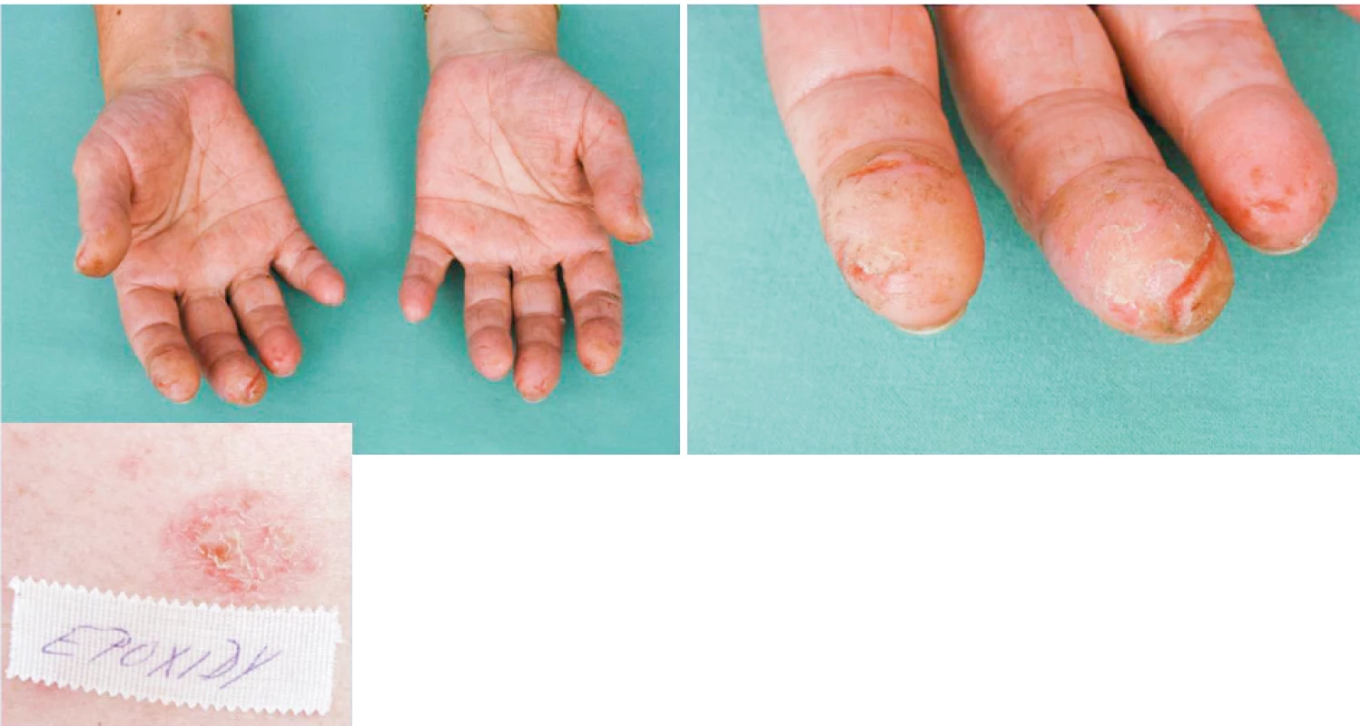 Eczema contactum prof. – epoxidy+++, tužidlo k epoxidům+++ (dietylentriamin) – dělnice
(práce na vrtačce)