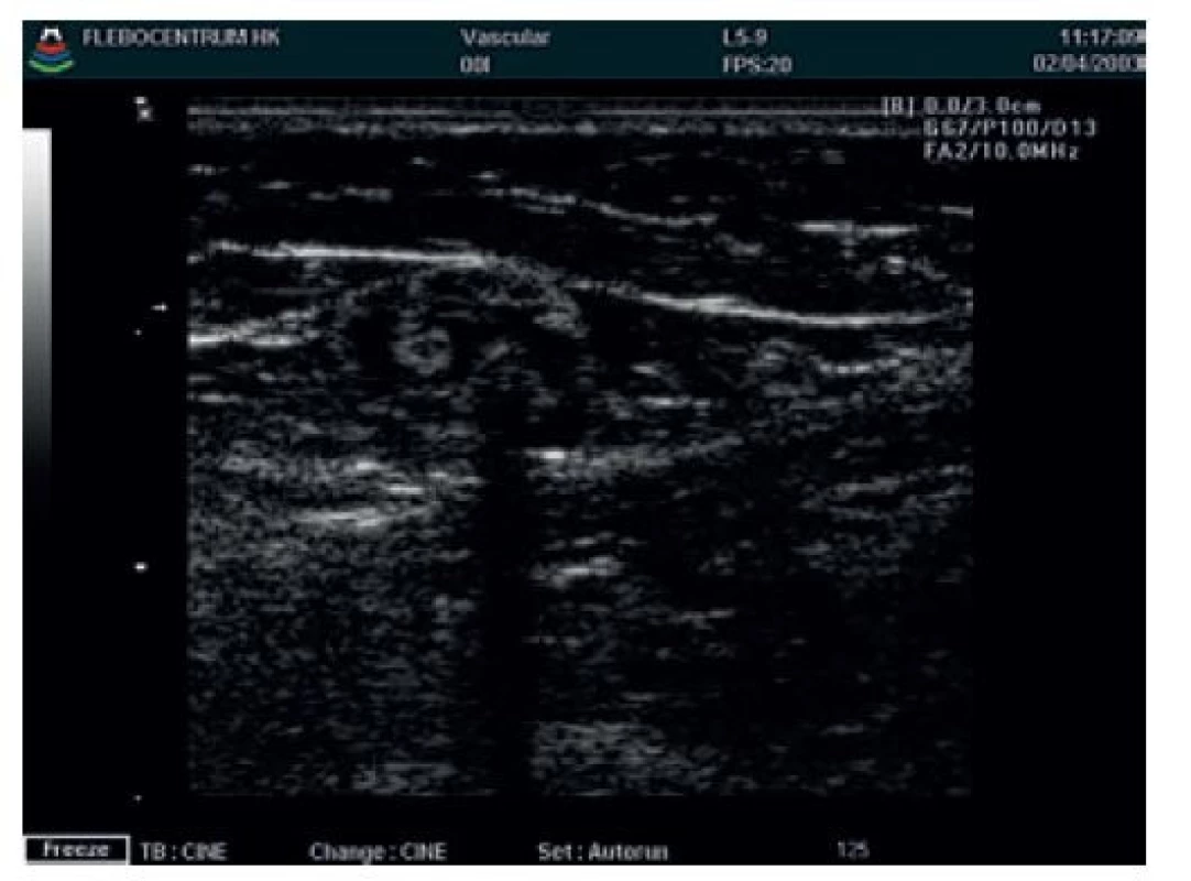 Tumescentní lokální anestezie v safenózním kompartmentu<br>
Fig. 2: Tumescent local anaesthesia in saphenous compartment