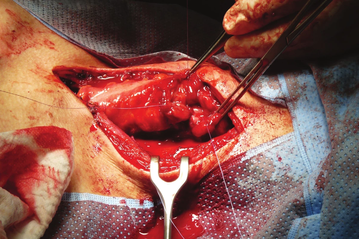 Anastomóza
krčního jícnu a interponátu
kolon protaženého
retrosternálně z laterální
krční incize<br>
Fig. 6: Anastomosis of
the cervical esophagus
and colonic interponate
drawn back from the
lateral cervical incision
retrosternally