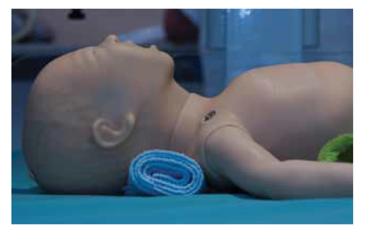 Správná poloha, hlava v neutrálním postavení.<br>
Fig. 4. Newborn with head in neutral position.