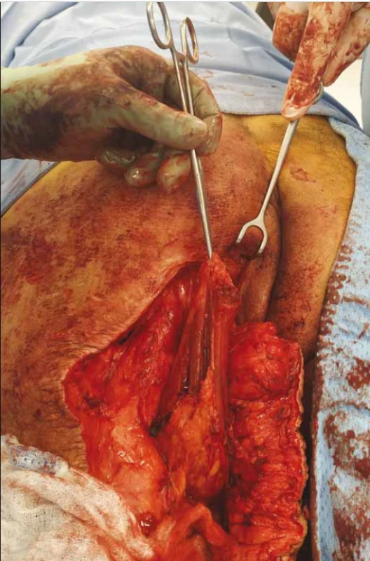 Semitendinosus muscle dissected and rotated.<br>
Obr. 2. Disekovaný a rotovaný semitendinózní sval.
