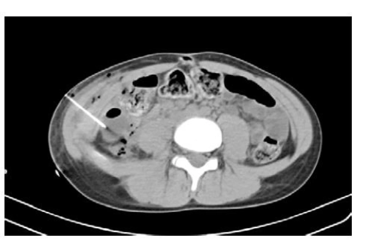 Reziduálního hematom a jeho drenáž pod
CT kontrolou 3. den po operační revizi a záchovném
výkonu na pravé ledvině<br>
Fig. 7. Residual hematoma and its drainage under
CT control on the 3rd day after surgical revision and
preservation on the right kidney