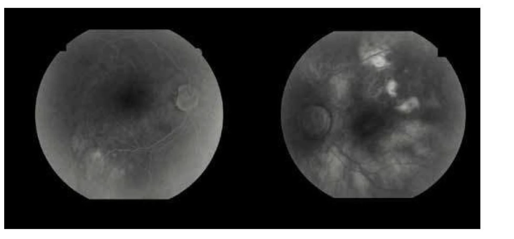 Na fluoresceínovej angiografii sa zobrazujú od počiatočných až po neskoré fázy hyperfluorescencie
v mieste kalcifikácii