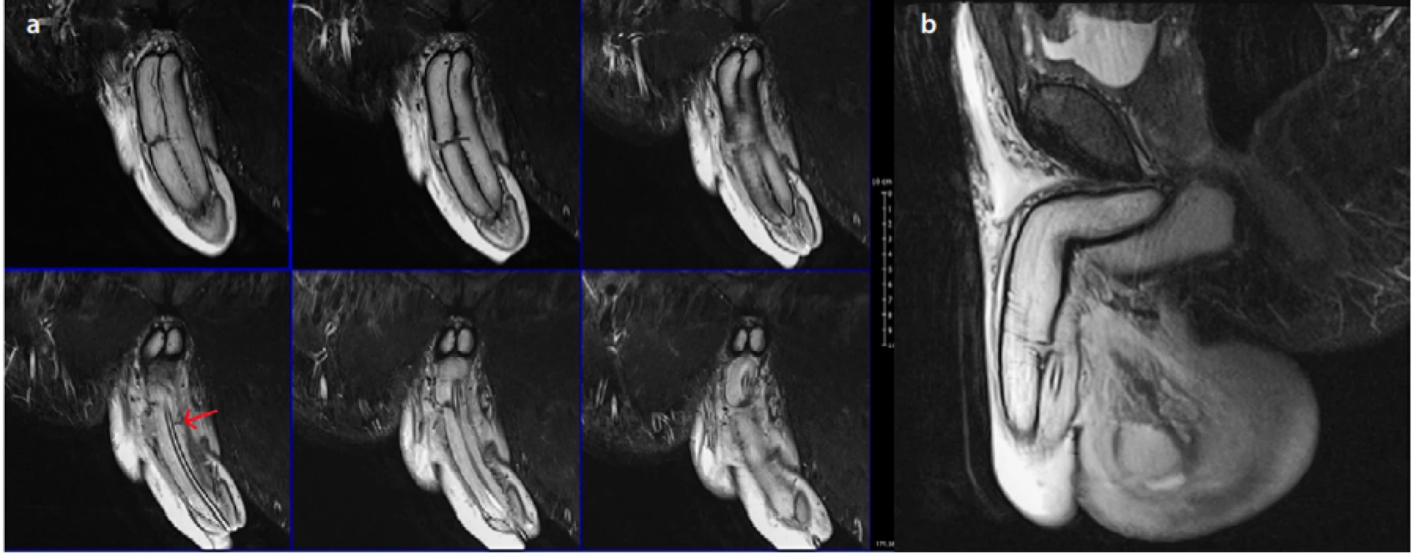 3T MRI penisu<br>
Fig. 2. 3T MRI of penis