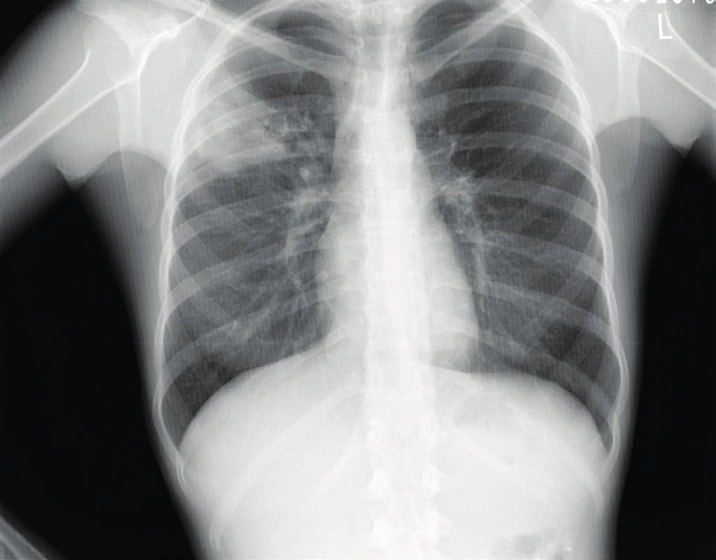 SKG hrudníku 17leté dívky. TB pneumonie vpravo, forma pneumonická mikroskopicky negativní, kultivačně
pozitivní.<br>
Fig. 2. Chest X-ray of 17 years old girl with pulmonary TB.
