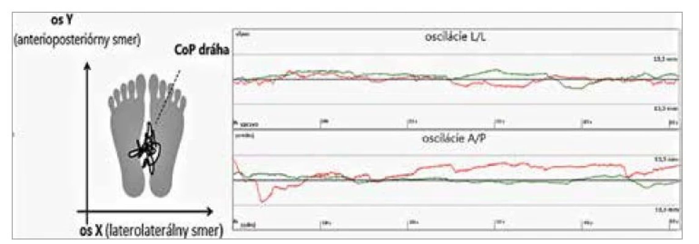 Príklad vyšetrenia oscilácie CoP (center of pressure) v anteroposteriórnom
smere (A/P) a laterolaterálnom smere( L/L).<br>
Fig. 2. Example of examination of centre of pressure oscillation in anteroposterior
direction (A/P) and laterolateral direction (L/L).