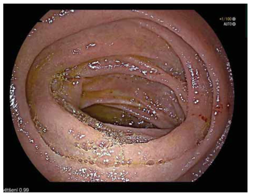 Endoskopické vyšetření po chirurgické resekci. Viditelná klidná, široká
anastomóza s fyziologickou sliznicí tenkého střeva.<br>
Fig. 5. Endoscopy after surgical resection. Visible calm, broad anastomosis with
physiological mucosa of the small intestine.