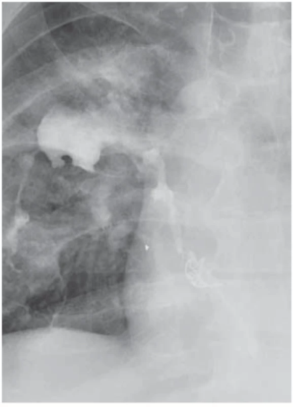 Persistent oesophagobronchial fistula after OTSC application
following wedge resection of the oesophagus.
Obr. 3. Perzistující ezofagobronchiální píštěl po klínovité resekci jícnu, stav po aplikaci OTSC klipu.