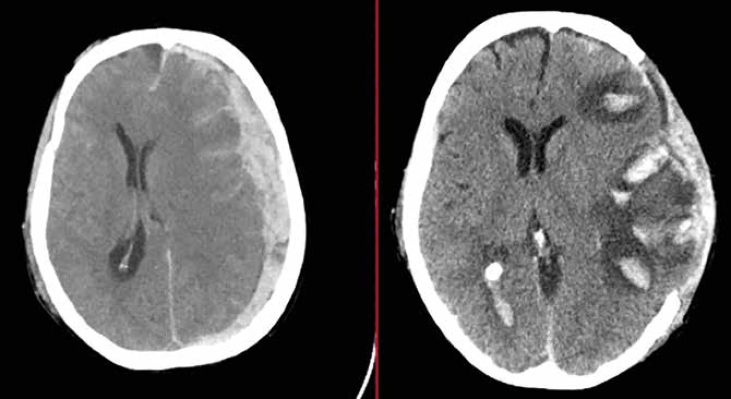 Hemoragická progrese kontuzních ložisek<br>
Fig. 2: Haemorrhagic progression of brain contusions