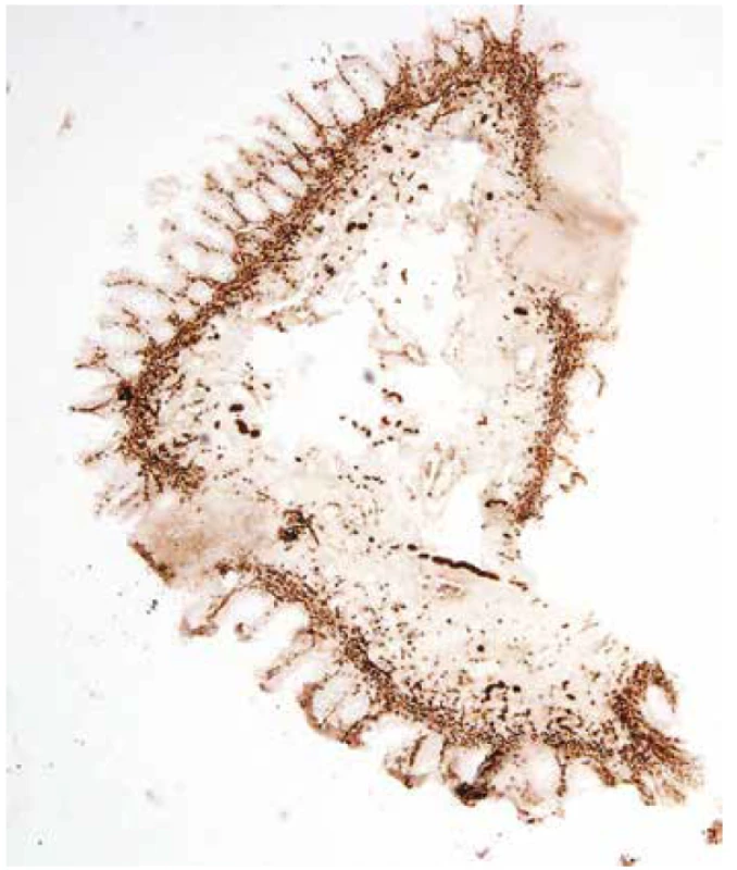 Silně pozitivní acetylcholinesterázová reakce, HN ultrakrátký segment,
1 cm od anu (iso-ACHE 40x).