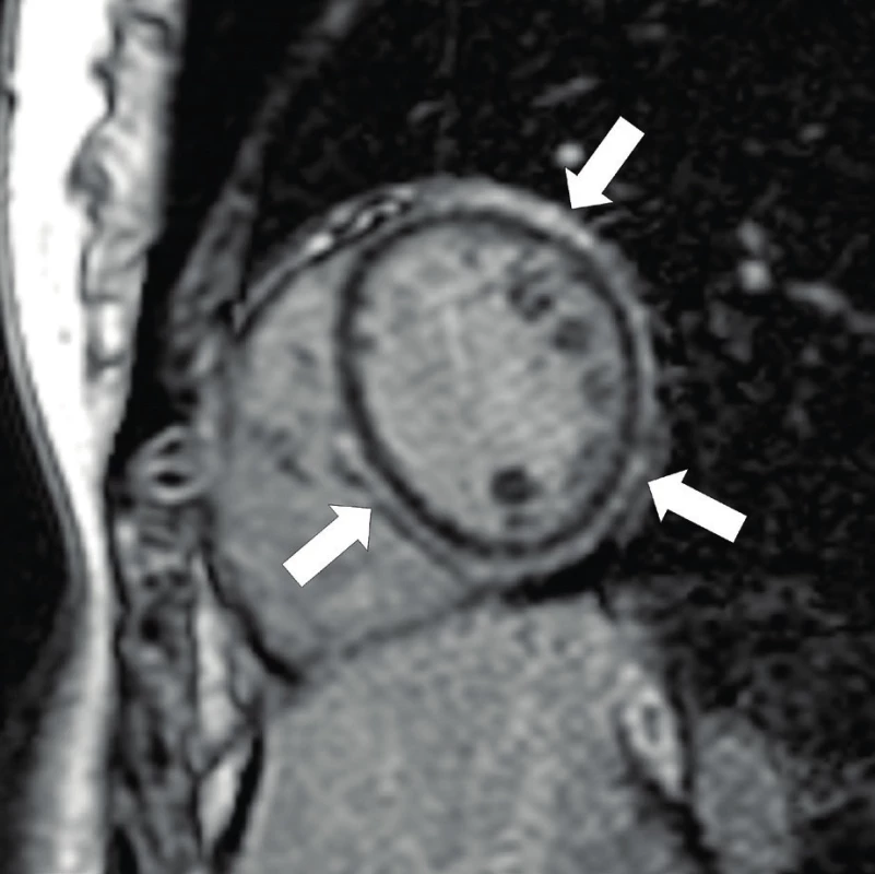  Arytmogenní kardiomyopatie – MRI pozdní sycení gadoliniem.  Vyšetření MRI zobrazuje pozitivní nález pozdního sycení gadolinia v myokardu v oblasti levé komory i části interventrikulárního septa – obraz tukové infiltrace a fibrózy (šipky).