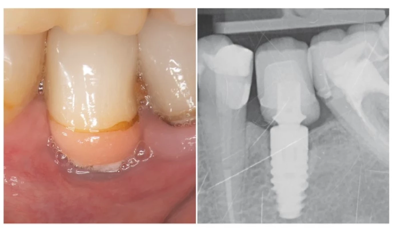Nesprávne zhotovená
korunka na DI v pozícii 35
neumožňujúca prístup
pomôckam dentálnej
hygieny.<br>
a – intraorálny pohľad<br>
b – rtg snímka<br>
Fig. 3
Improper single-tooth
implant restoration.<br>
a – intraoral view<br>
b – X-ray