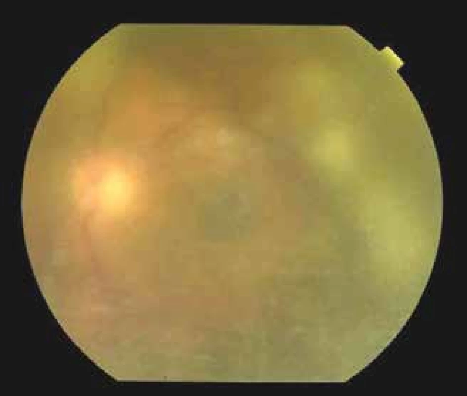 Finding on ocular fundus of left eye, regression of
exudation in vitreous body with showing through of an
optic nerve disc 7 days after commencement of therapy
