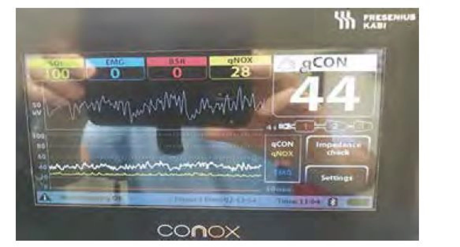 Displej monitoru CONOX ukazuje nad syrovou křivkou EEG kvalitu
signálu (SQI), EMG aktivitu, BSR a indexy qNOX (ukazatel antinocicepce,
v rozmezí 40–60 je reakce pacienta na nociceptivní podnět nepravděpodobná)
a qCON (doporučené rozmezí pro anestezii 40–60). V dolní části je
zobrazen trend jednotlivých parametrů v období 60 minut