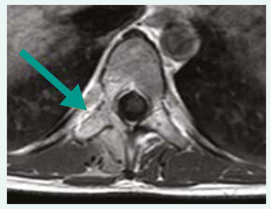 Control MRI after 3 months showing
regression of SEA, transversal scan.
Department of Radiology, and Nuclear Medicine