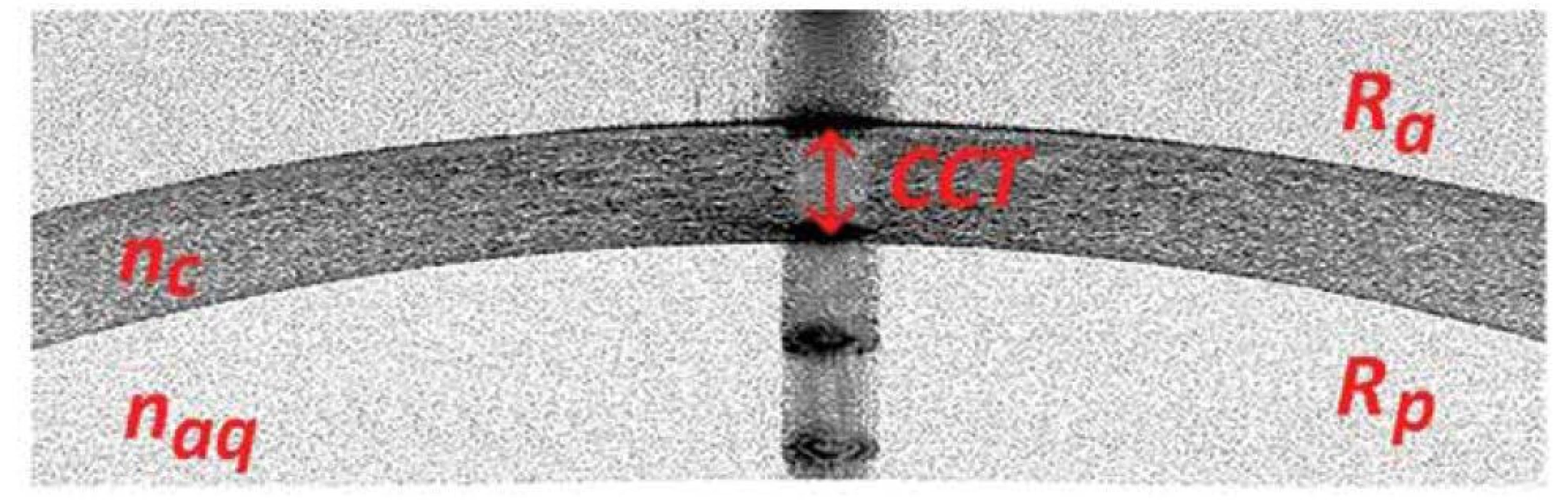 Ukázkový snímek tomografického řezu centrální části rohovky o průměru 3 mm<br>
Ra – radius přední plochy rohovky, Rp – radius zadní plochy rohovky, nc – index lomu rohovky, naq – index
lomu komorové tekutiny, CCT – centrální pachymetrie