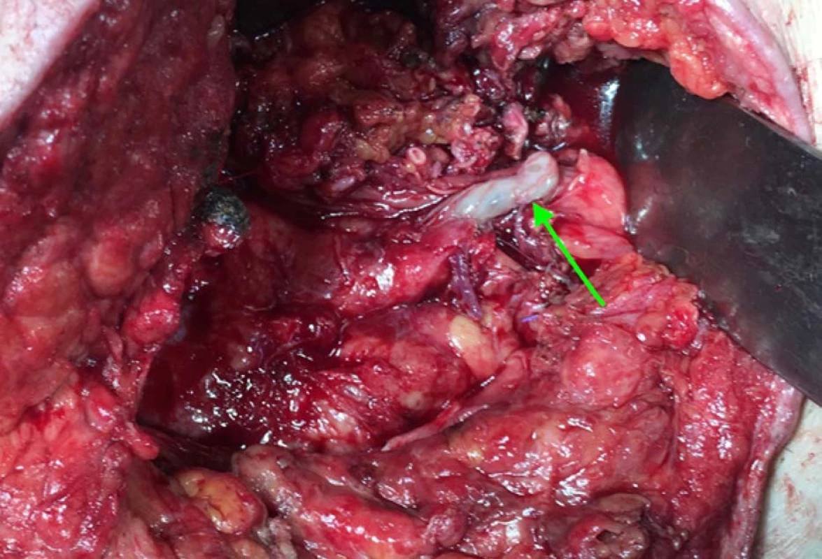 Nekróza terminálneho úseku močovodu transplantovanej obličky<br>
Fig. 6. Necrosis of the terminal ureter of the transplanted kidney
