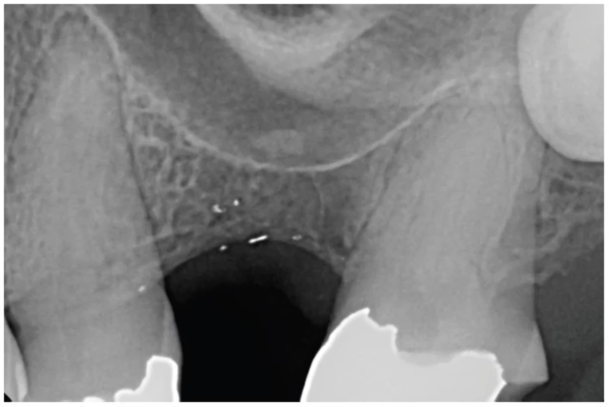RTG snímek oblasti
chybějícího levého horního
prvního moláru před
implantací ukazuje konkávní
tvar alveolárního recesu
čelistní dutiny <br> 
Fig. 1 Radiographic image of the
area of the missing left
maxillary first molar prior to
the implant insertion showing
a concave shape of the
alveolar recess of the maxillary
sinus