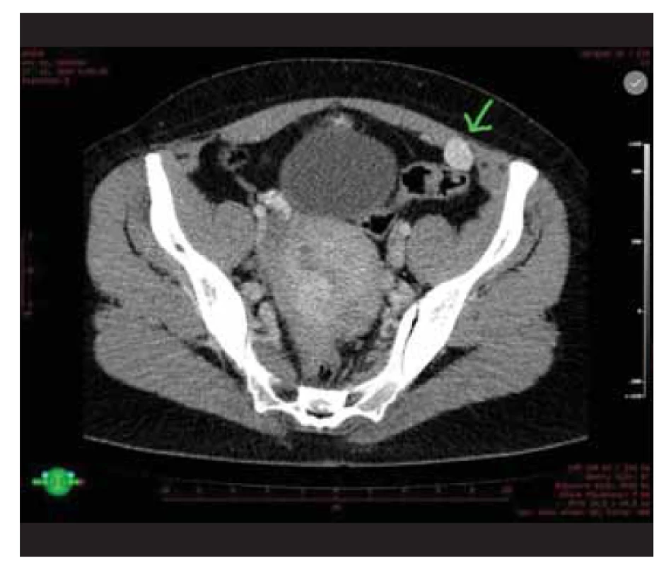 CT nález parazitárního leiomyomu uloženým retroperitoneálně
mezi přímým a šikmým svalem břišním.<br>
Fig. 1. CT finding of parasitic leiomyoma located retroperitoneally
between the rectus abdominus and the oblique abdominal
muscle.