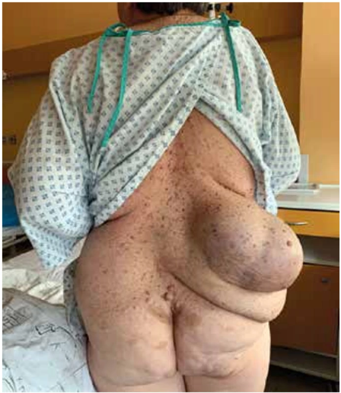 Fotografie pacientky s lumbální kýlou před operací <br>
Fig. 1. Photography of the patient with lubar hernia before the operation