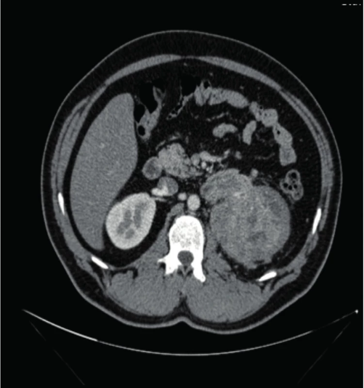 CT nález tumoru levé ledviny s nádorovým
trombem renální žíly a postižením uzlin<br>
Fig. 1. CT finding of the left kidney with tumor, tumor
thrombus of the renal vein and nodal involvement