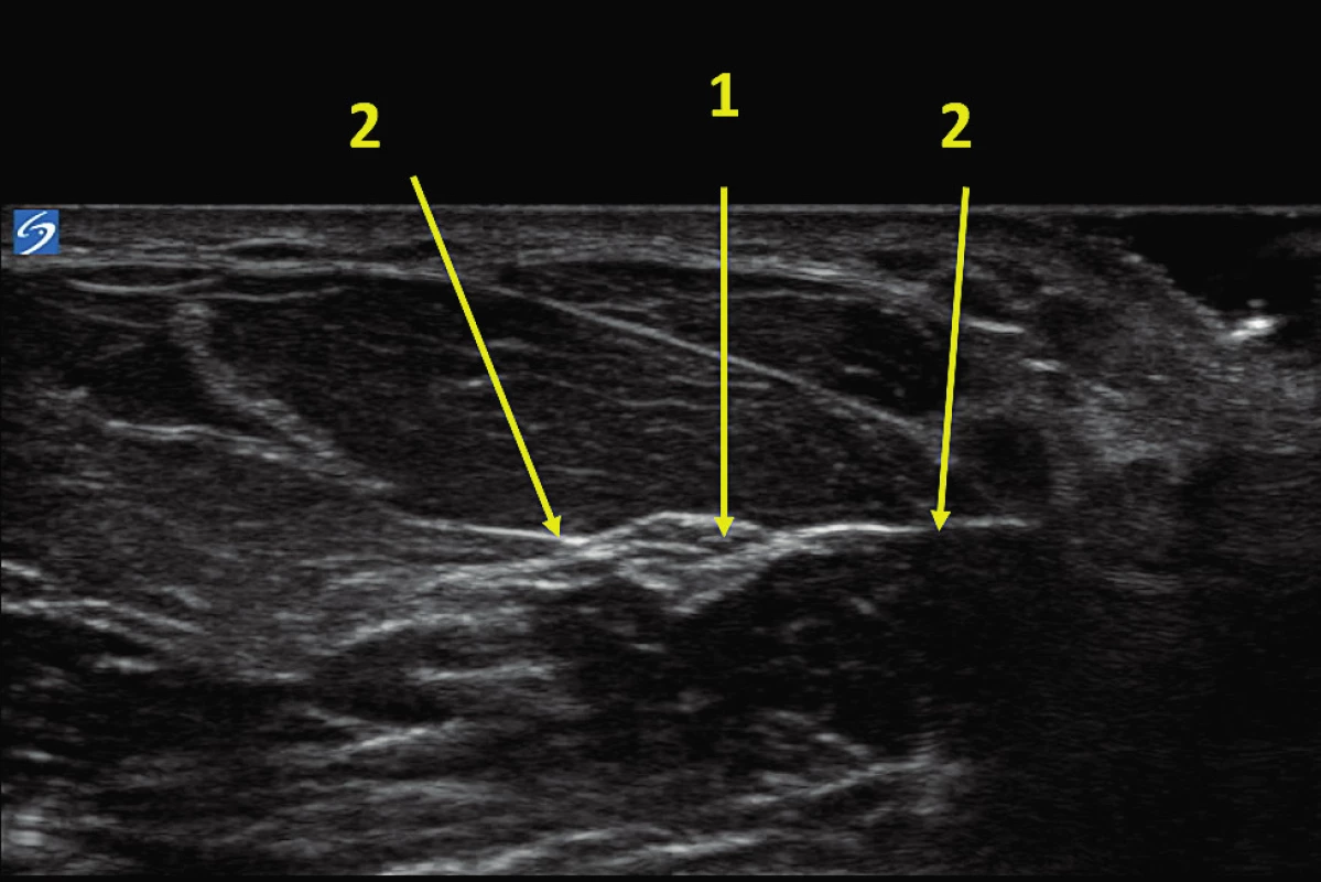 UZ obraz n. medianus<br>
1 – nervus medianus, 2 – fascie mezi povrchními a hlubokými
flexory ruky