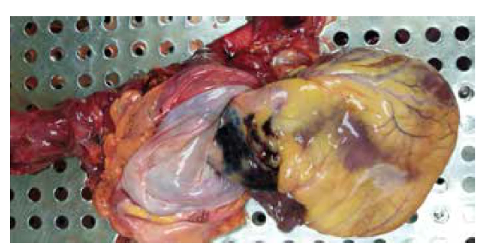 Hematom v oblasti ascendentní aorty. <br>
Fig.1. Hematoma of ascending
aorta.