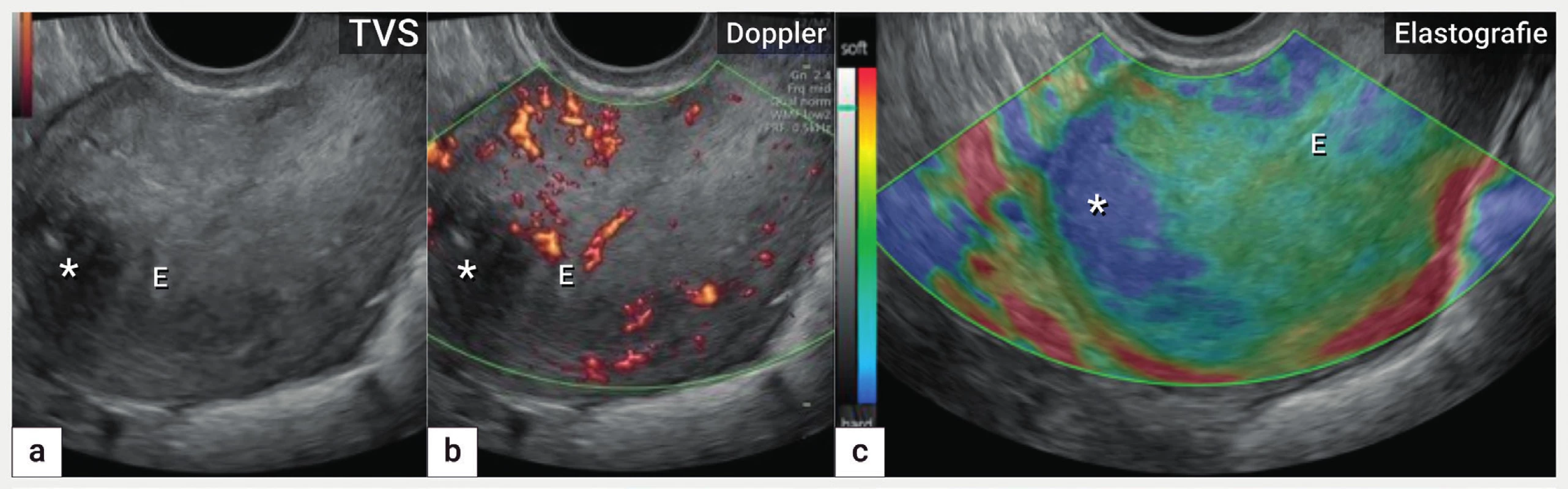 Elastografie<br>
Ultrazvukové zobrazení dělohy (B-mode, škála šedi) s koncentricky zesílenou přední a zvláště zadní stěnou na podkladě adenomyózy
(a), zobrazení barevným dopplerem s nezměněnou perfuzí v přední a zadní stěně děložní (b), elastografie s označením fibrotických změn
hvězdičkou (modrá oblast) uložených převážně ventrálně ve fundu (c).
E – endometrium