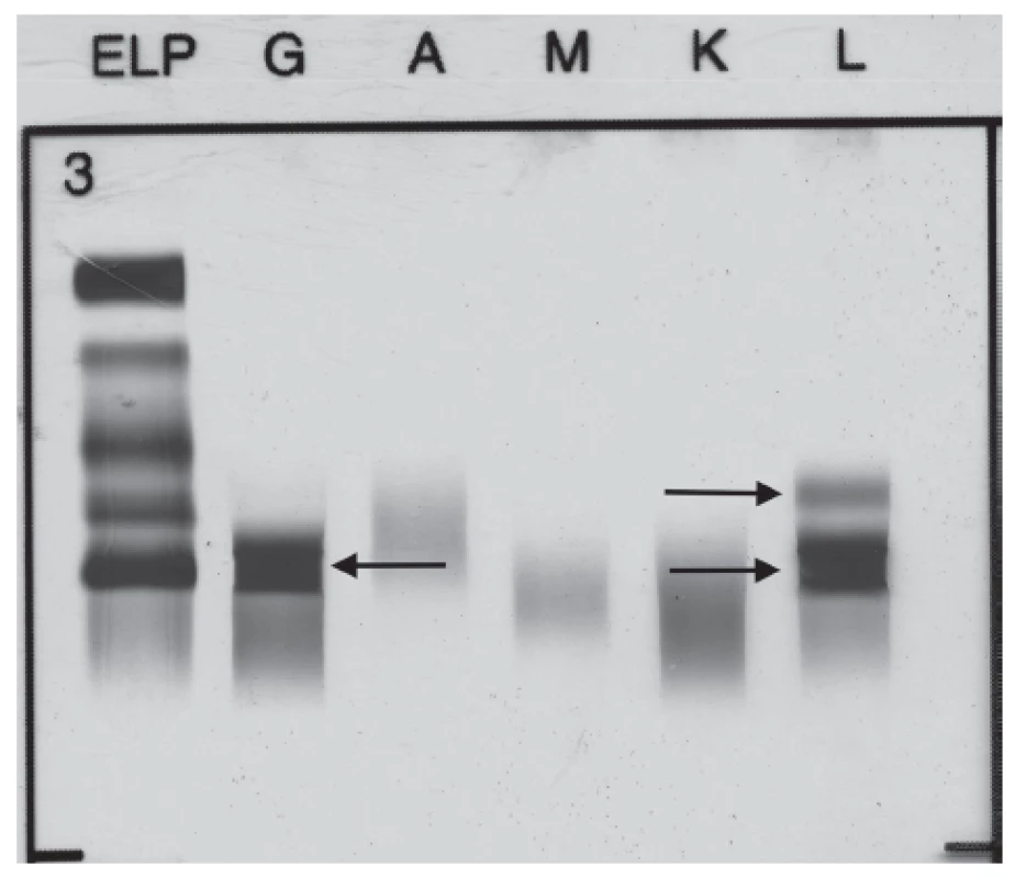 Immunofixation electrophoresis of patient´s serum sample
presenting paraprotein IgG Lambda and FLC Lambda.