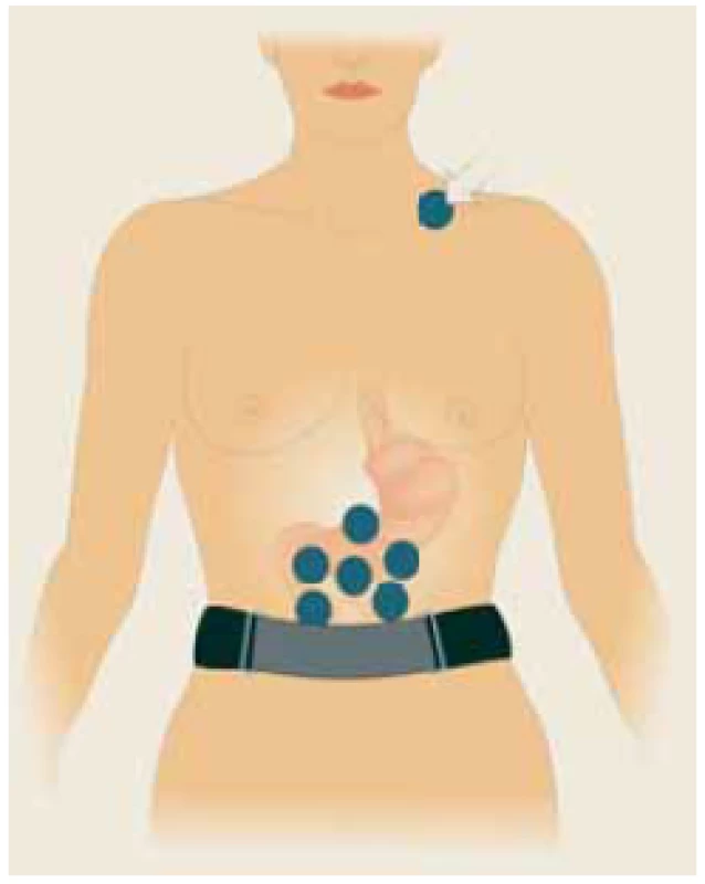 Six self-adhesive electrodes
placed on the upper part of the abdomen,
the ?th electrode (basal) placed
in the left supraclavicular area
(arrow). A special abdominal belt
(respiratory sensor) is used to identify
artefacts caused by breathing and
body movements. Drawing: Hana
Kotlandová.<br>
Šest samolepících elektrod
umístěných v horní části břicha,
?. elektroda (bazální) umístěná v levé
supraklavikulární oblasti (šipka).
Speciální břišní pás (respirační senzor)
se používá k identifi kaci artefaktů
způsobených dýcháním a pohyby těla.
Kresba: Hana Kotlandová.