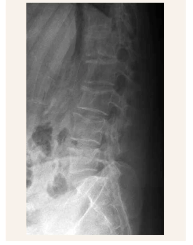 RTG LS páteře pacientky s prořídlou strukturou
obratlových těl (archiv Radiologické kliniky,
FN a LF UP Olomouc)