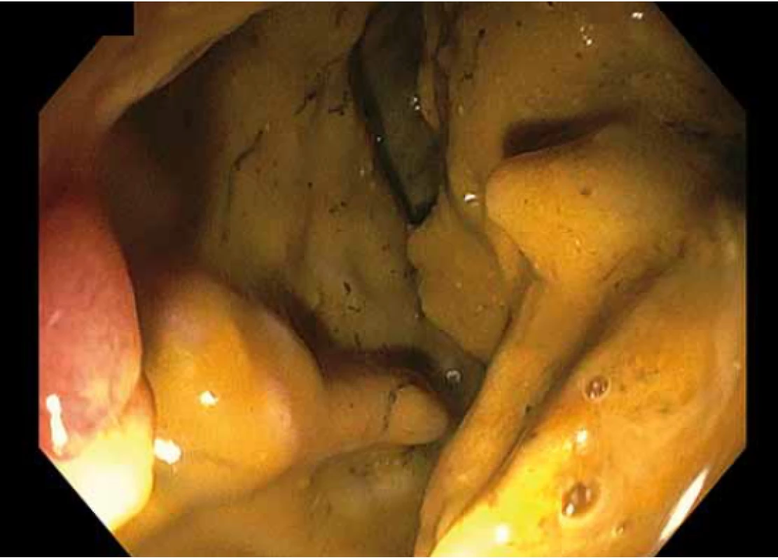 Kvalita střevní přípravy dle BBPS – hodnocení
0 bodů.<br>
Fig. 4. Quality of intestinal preparation according to BBPS –
0 points.<br>
BBPS – Boston Bowel Preparation Scale
