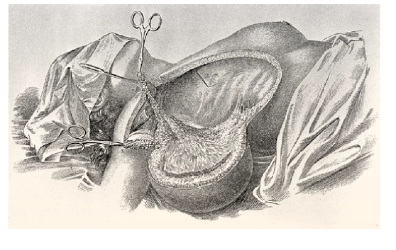 Radikální mastektomie dle Halsteda. Zdroj: Wikimedia Commons
(CC BY 4.0)
