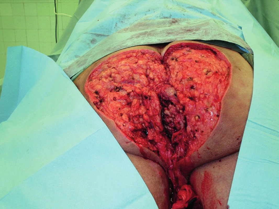 Pooperační nález<br>
Fig. 3: Postoperative finding
