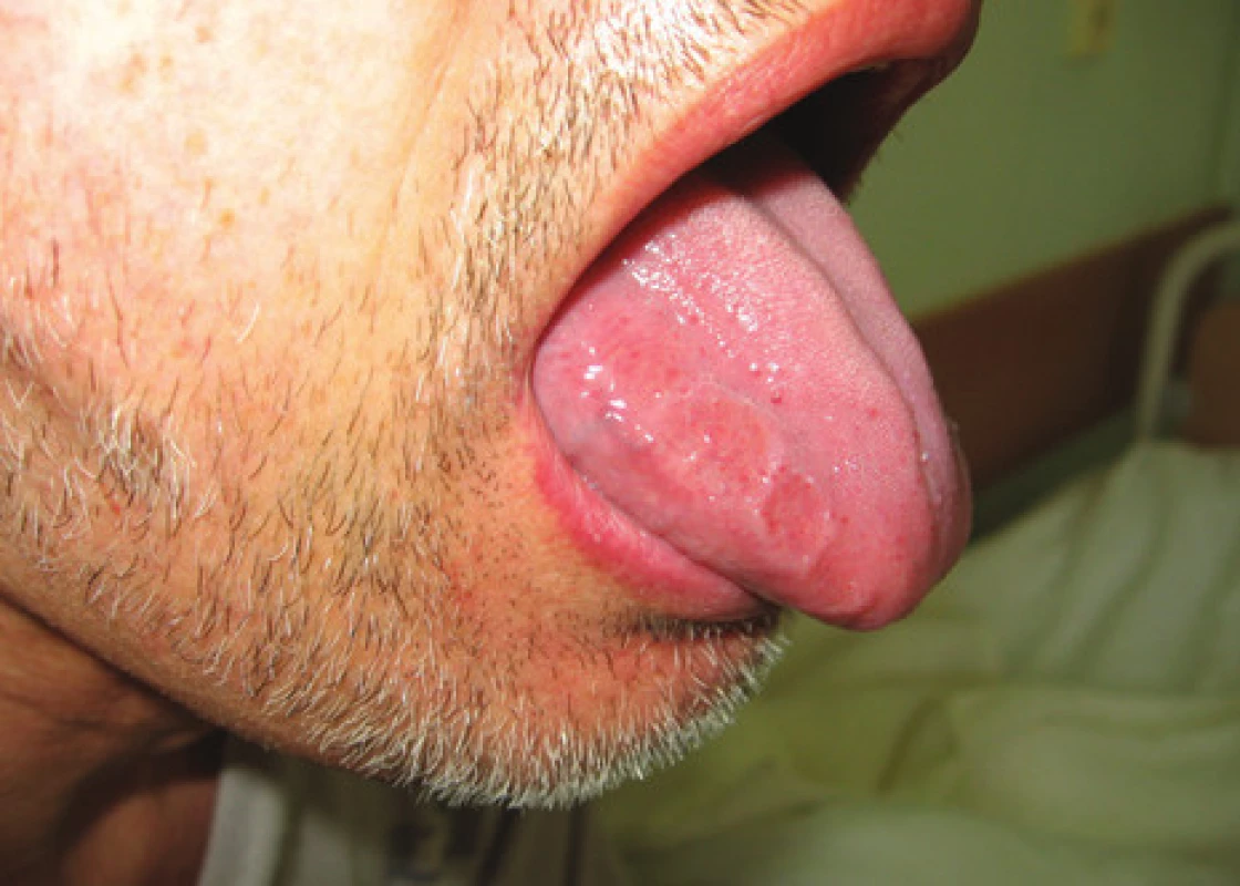 Infitrace jazyka při AL amyloidóze s imprinty zubů.<br>
Fig. 1. Tongue infiltration with AL amyloidosis with tooth imprints.
