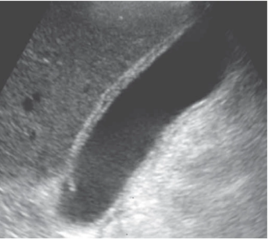 Ultrasonografi e hepatobiliárního systému, detekce
zvětšeného žlučníku s drobnou lithiázou, lehce zesílenou,
stratifi kovanou stěnou, při dózované kompresi výrazná
citlivost – obraz lehké akutní cholecystitidy.<br>
Fig. 6. Ultrasonography of the hepatobiliary system, showing
an enlarged gallbladder with a small presence of lithiasis,
a slightly thickened, stratifi ed wall, and signifi cant sensitivity during dosed compression – image of mild acute
cholecystitis.