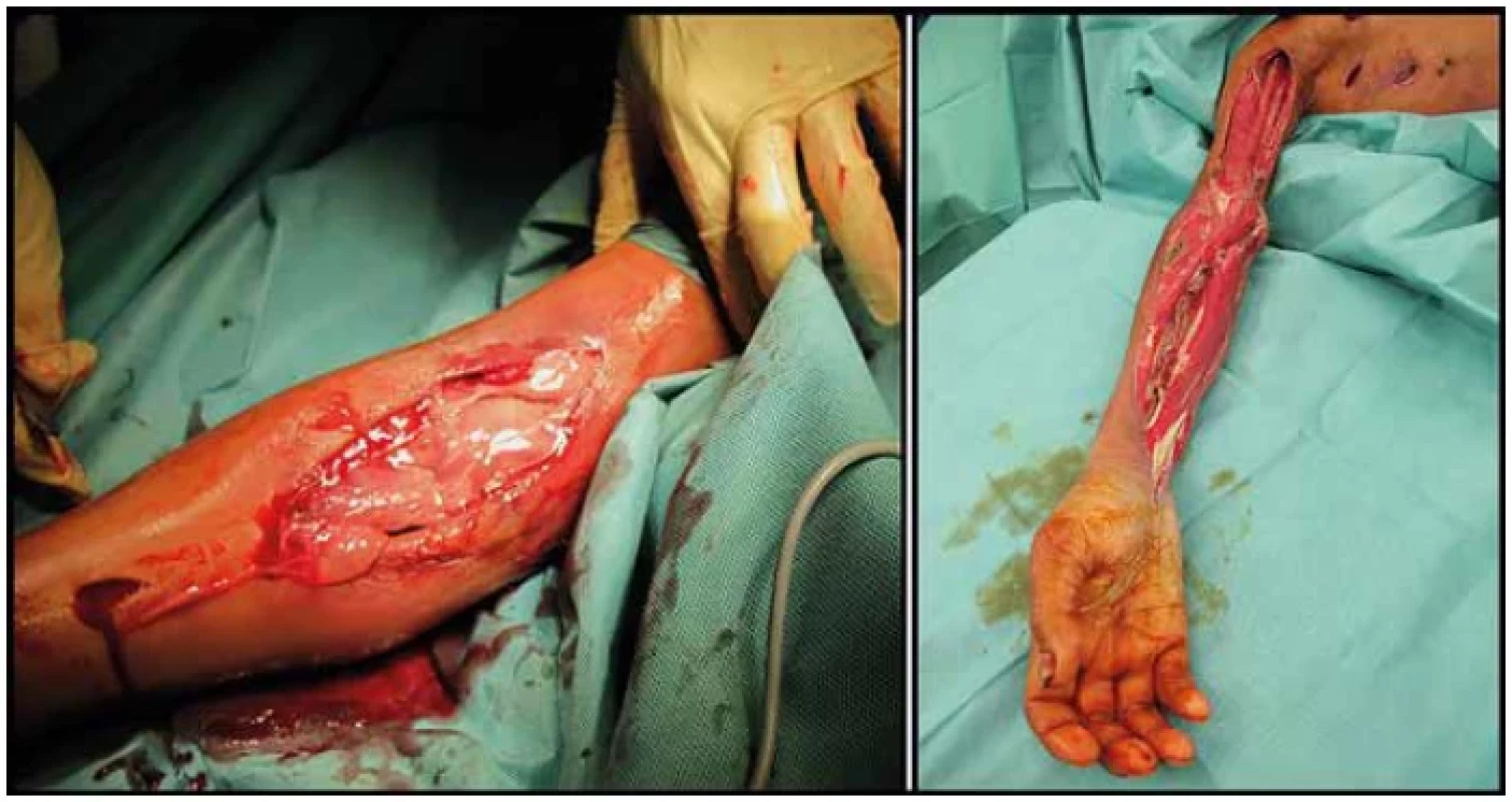 Perioperative photography of the tissues on the day of the second hospital admission (left) and during one of the
final dressings before the transhumeral amputation (right)