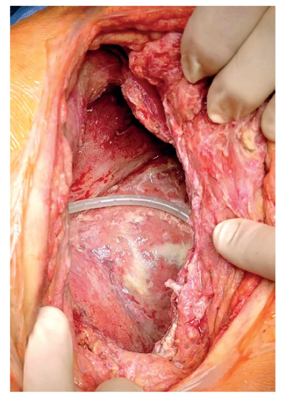 Stav stěn pleurální dutiny při převazu 4. 2. 2020.<br>
Fig. 4: Condition of pleural cavity walls during dressing
change on February 4, 2020