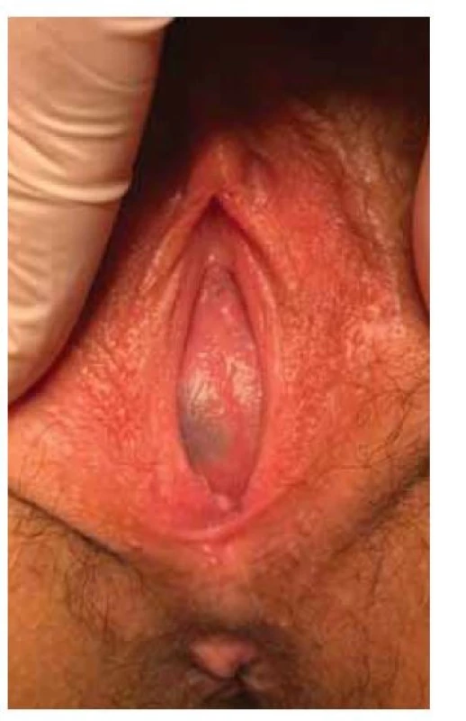Hymenální atrezie s hematokolpos
(archiv autora).<br>
Fig. 1. Hymenal atresia with hematocolpos
(author’s archive).