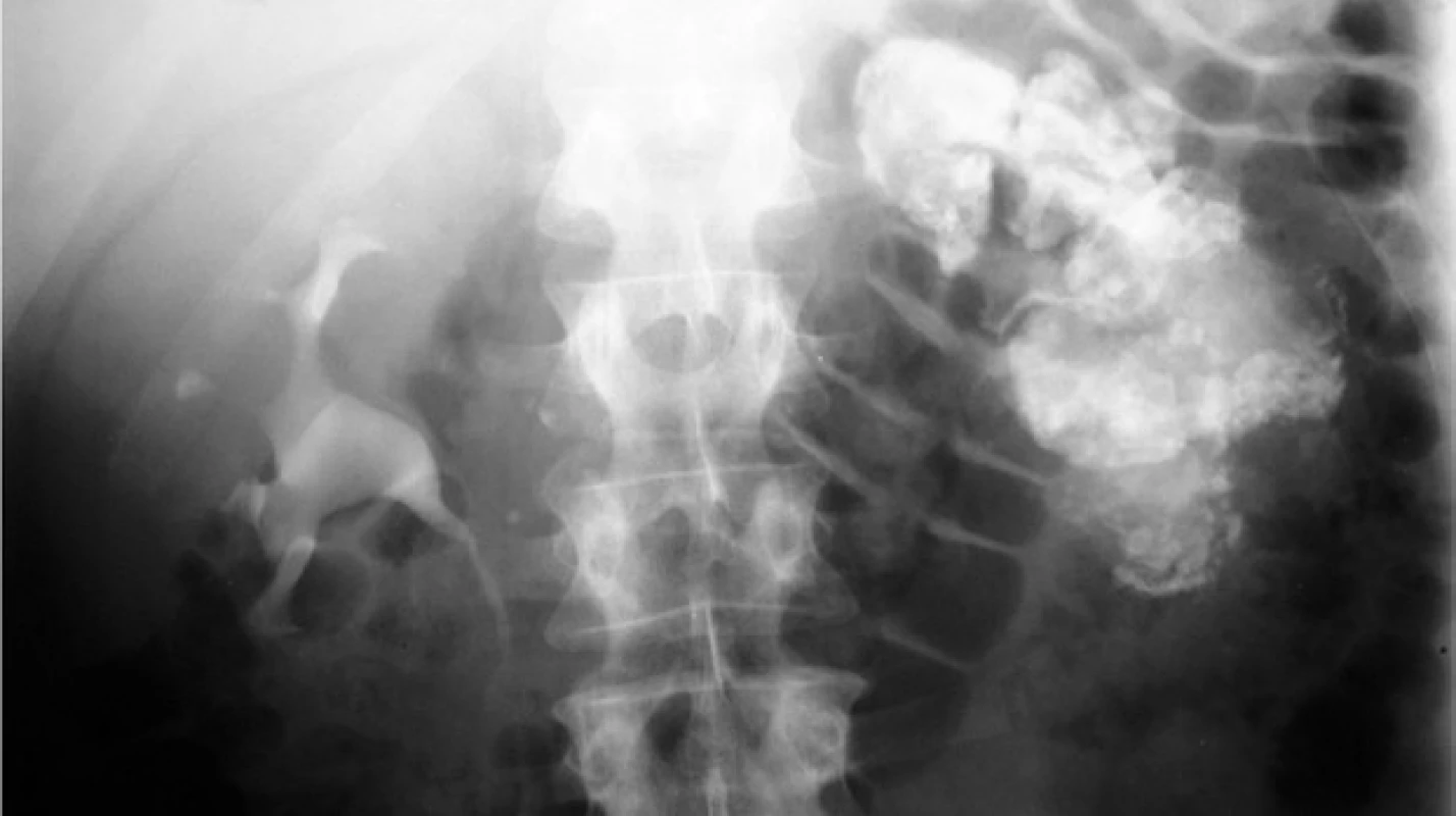 Vylučovací urografie: autoamputace
ledviny – těžce malformovaný
dutý systém a parenchym
levé afunkční ledviny, vyplněny kalcifikovanými
kaseózními hmotami<br>
Fig. 4. Excretory urogram: autoamputation
of the kidney – extensively
distorted collecting system
and parenchyma of non-functioning
left kidney, filled with calcifications
and caseous substance