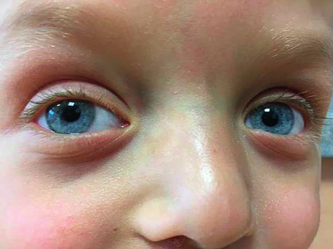 Nápadně modré oči u chlapce se syndromem
Noonanové a patogenní variantou genu PTPN11. Oba
rodiče mají oči hnědé.<br>
Fig. 2. Strikingly bluish eyes in a boy with Noonan syndrome
due to a pathogenic PTPN11 gene variant. In both parents, their eyes are brownish.