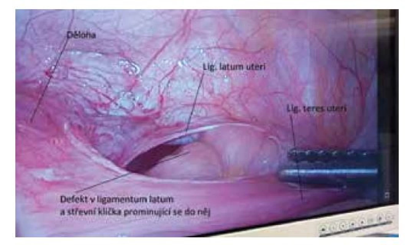 Peroperační nález<br>
Fig. 5: Perioperative finding