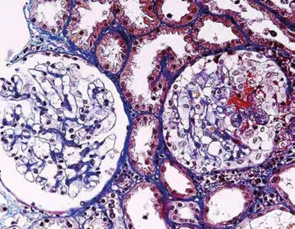 <b>Časná fáze ANCA pozitivní GN,</b> s normálním glomerulem vlevo. Vpravo s fibrinoidní nekrózou (kapilaritidou) a se segmentálním epitelovým srpkem (barvení AFOG).