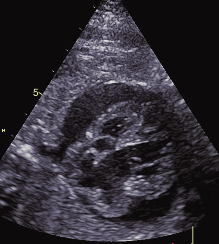 Fetální hypertrofická kardiomyopatie s perikardiálním
výpotkem.<br>
Fig. 2. Fetal hypertrophic cardiomyopathy with pericardial
effusion.