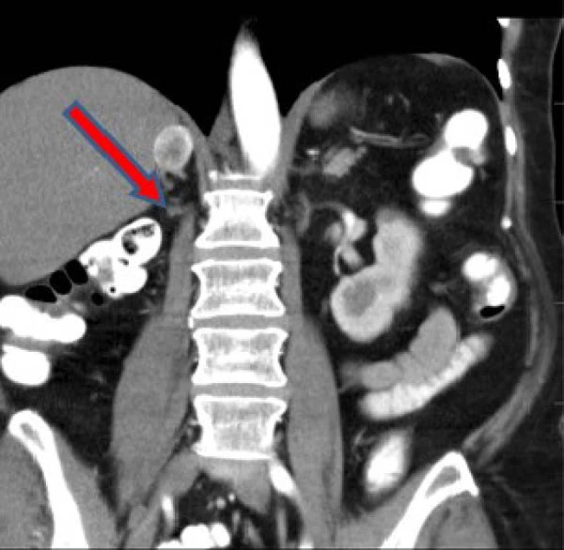 Metastáza nadledviny vpravo
dle CT z druhé poloviny května 2016<br>
Fig. 2. Metastasis of adrenal gland
right – CT May, 2016