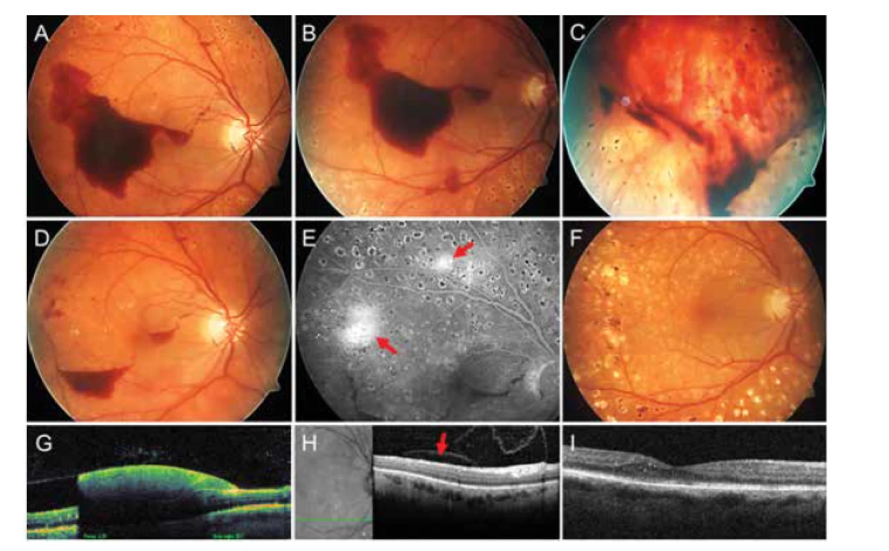 Subhyaloidní krvácení na pravém oku pacientky č. 2 (A), bezprostředně po
provedené Nd:YAG laserové hyaloidotomii (B, C), týden po provedené Nd:YAG laserové
hyaloidotomii (D), pozdní fáze fluorescenční angiografie (E) s aktivními neovaskularizacemi
sítnice (označeny šipkami), stabilizovaný nález po 27 měsících (F). Lineární
transfoveolární horizontální sken pomocí optické koherenční tomografie dokumentuje
subhyaloidní krvácení (G), lineární horizontální inferoextrafoveolární sken s reziduální
subhyaloidní kapsou (označena šipkou) za 1 měsíc (H) a lineární horizontální transfoveolární
sken 27 měsíců po provedené Nd:YAG laserové hyaloidotomii (I)