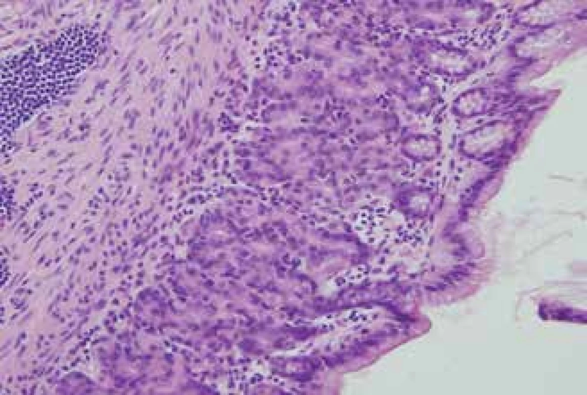 Jeden z histologických vzorků ukazující střevní
sliznici. Hematoxylin a eosin, zvětšeno 200x