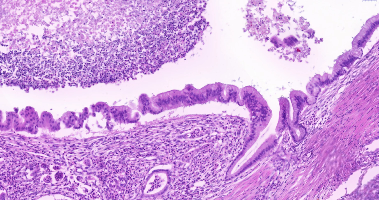  Biliární intraepitelová neoplazie stupně 3 (BiIN 3) v extrahepatálním žlučovodu. V levé části snímku je vidět víceřadý epitel s variací velikosti a tvaru jader s mikropapilárními prominencemi a se ztrátou polarity epitelu (jádra jsou i v apikální části epitelu). Pro srovnání je vpravo včetně slizničního záhybu patrný normální biliární epitel bez dysplazie, tzn. jednořadý cylindrický epitel s malými kulatými stejnoměrnými jádry situovanými při bazi epitelu. Pod dysplastickým epitelem je patrné desmoplastické stroma a drobné žlázky invazivního adenokarcinomu. V lumen žlučovodu je nekrotické debris a neutrofily. Histologický řez z chirurgického resekátu, hematoxylin-eozin, 20×.